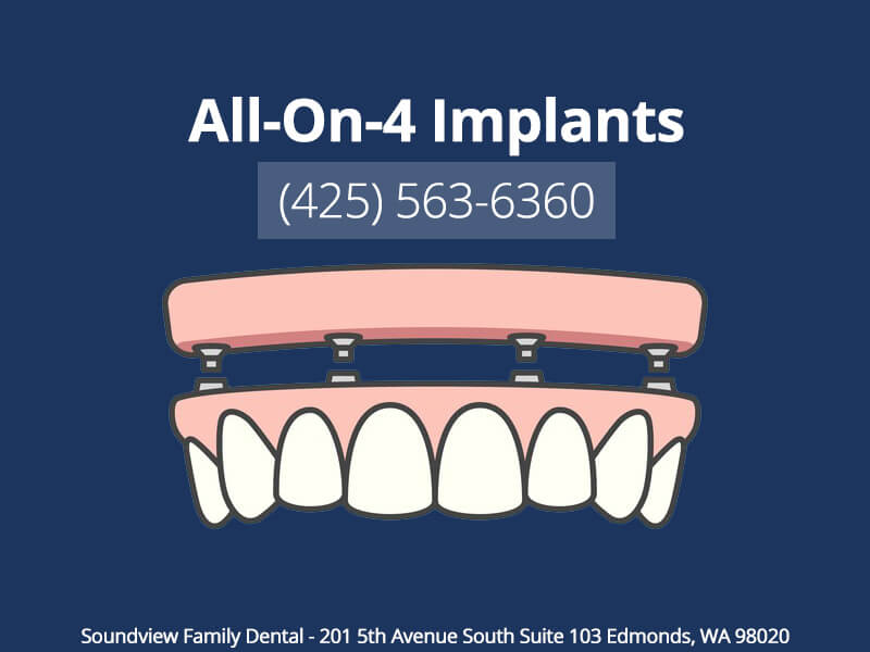 All On 4 Implants