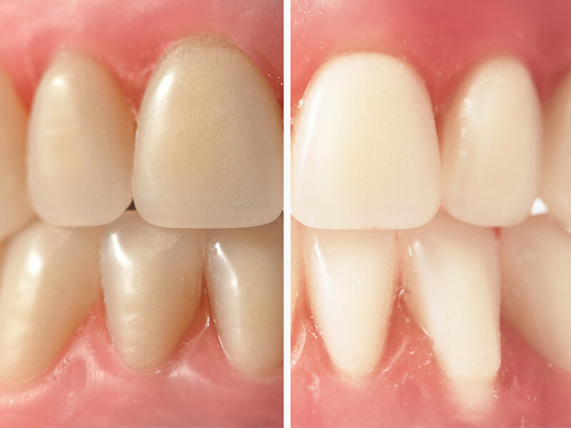 Single Tooth Dental Bridge