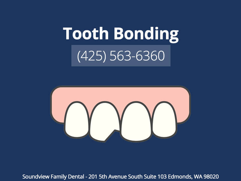 Tooth Bonding