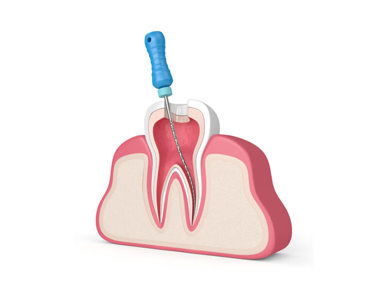 Root Canal Therapy With Instrument