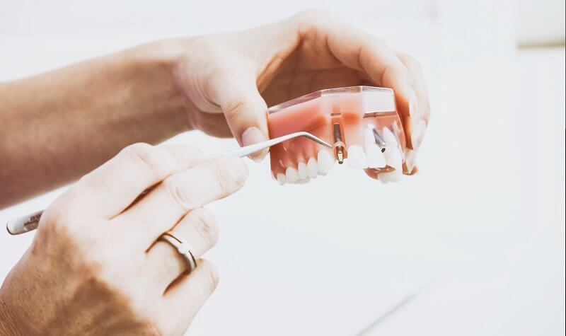 Person holding dental implants