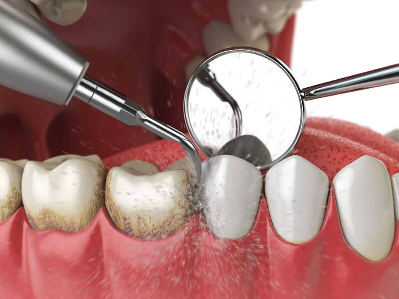 Tooth Polish During Cleaning