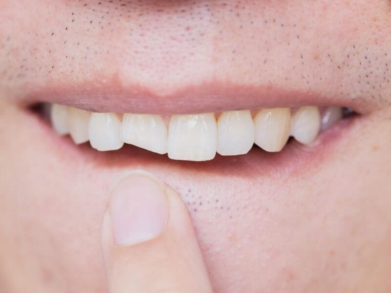 how to fix a broken tooth at home