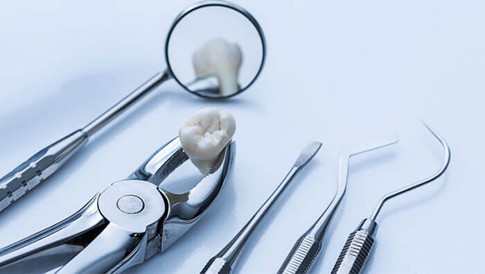 How Soon After Tooth Extraction Can You Have An Implant?