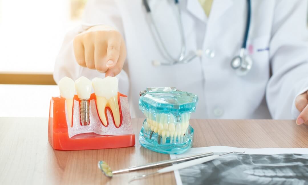 Dental Implant Care After Surgery