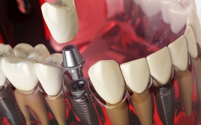 Can You Have a Full Mouth of Dental Implants?