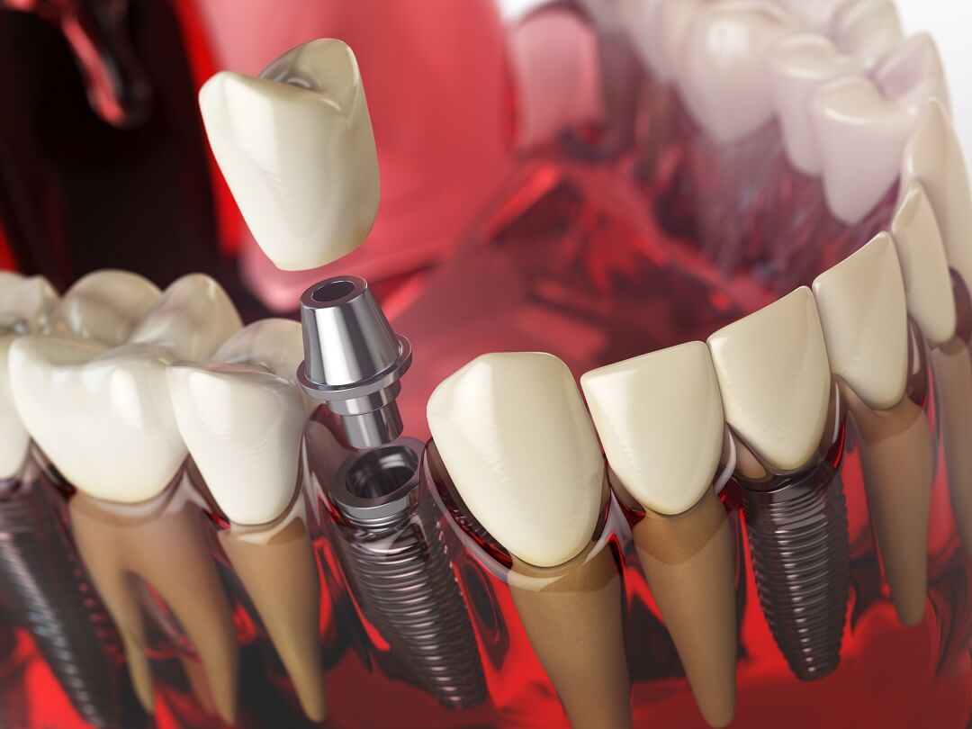 Can You Have a Full Mouth of Dental Implants