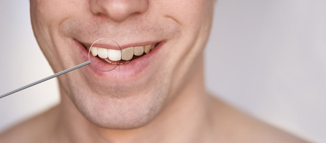 A man smiling showing his teeth before and after whitening