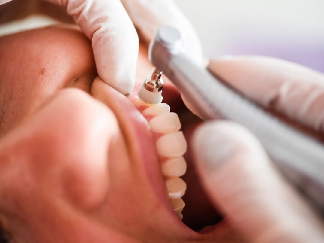 Are Dental Cleanings Necessary?