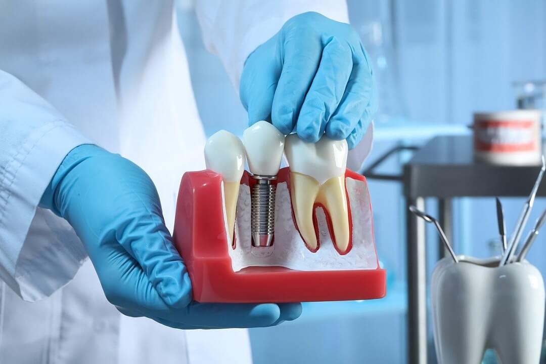 Are Dental Implants Safe and How Long Do They Last?
