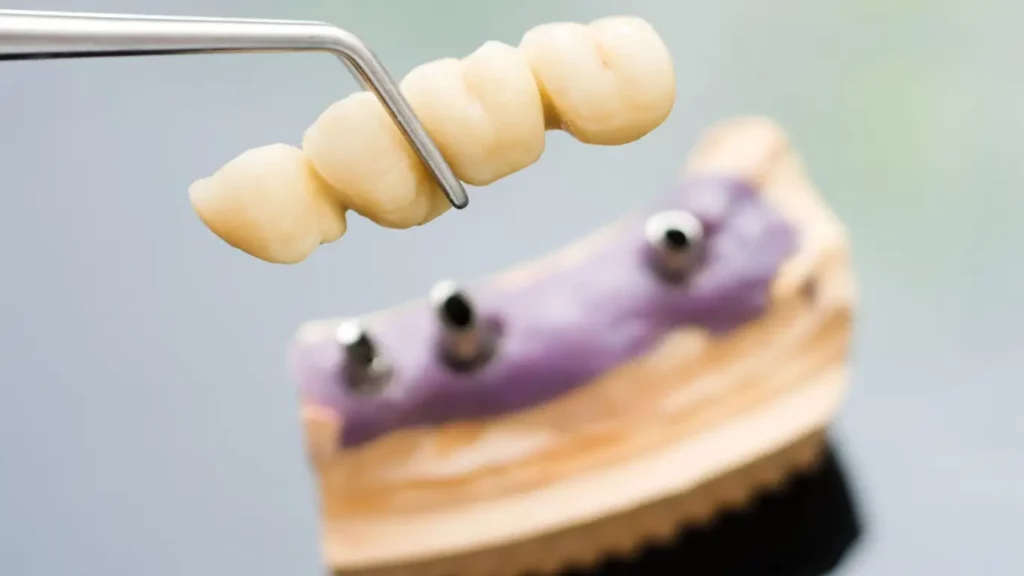 Dentist implanting dental head and bridge